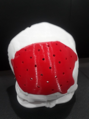 Mảnh ghép hộp sọ bằng vật liệu PEEK theo công nghệ in 3D của Công ty Y Sinh Ngọc Bảo